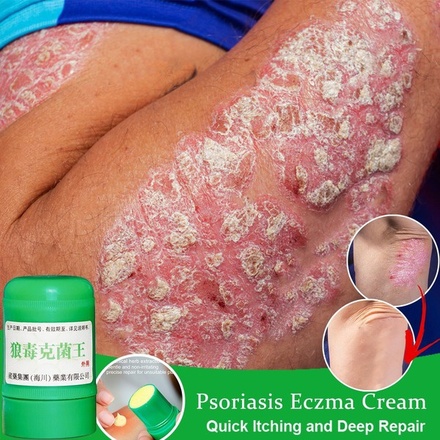 1pc Skin Psoriasis E...